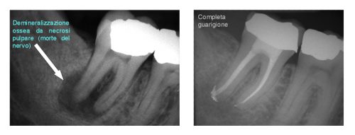 endodonzia1