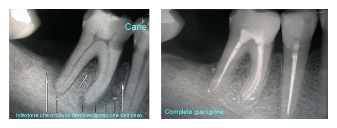 endodonzia2